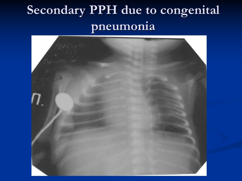 Secondary PPH due to congenital pneumonia